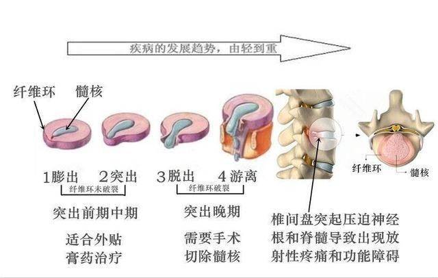 腰间盘突出最新疗法｜腰突新治疗法探秘