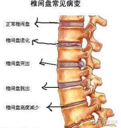 腰椎间盘突出最新疗法｜腰椎间盘突出治疗新进展