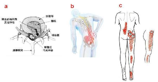 腰椎间盘突出最新疗法｜腰椎间盘突出治疗新进展